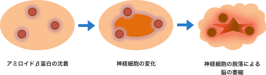 図1. アミロイドβ蛋白（Aβ）の脳内沈着からの脳萎縮