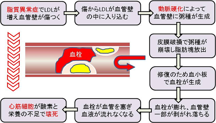 図1. 脂質異常症⇒動脈硬化⇒心筋梗塞となる仕組み