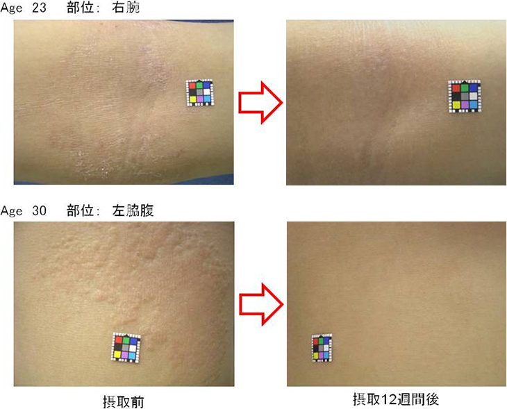 写真1. 難消化性αオリゴ糖摂取によるアトピー性皮膚炎症状の改善例