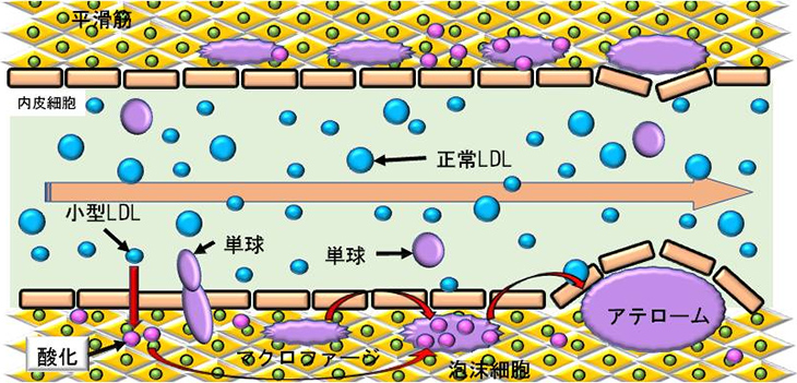 図5. 小型LDLが動脈硬化を引き起こすメカニズム