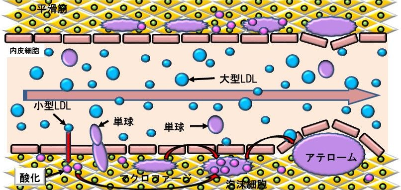 図5. 小型LDL比が動脈硬化を引き起こすメカニズム